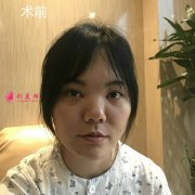 上海華美整形膨體+鼻中隔軟骨鼻綜合手術(shù)恢復(fù)效果分享