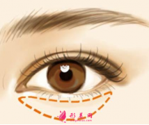 祛眼袋手術(shù)失敗會(huì)出現(xiàn)什么問(wèn)題？