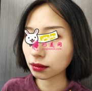 深圳藝星醫(yī)療美容醫(yī)院膨體隆下巴案例 秒變瓜子臉 自然不生硬