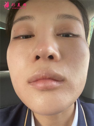 成都鼻綜合手術術后恢復情況分析