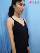 上海九院自體脂肪隆胸怎么樣？小姐姐脂肪胸案例分享