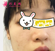 重慶軍科整形醫(yī)院光子嫩膚祛痘印效果好明顯 臉蛋真干凈