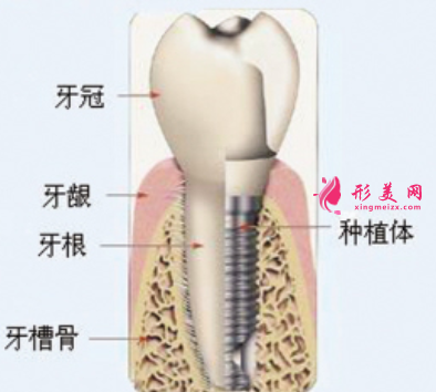 種植牙可以使用多久