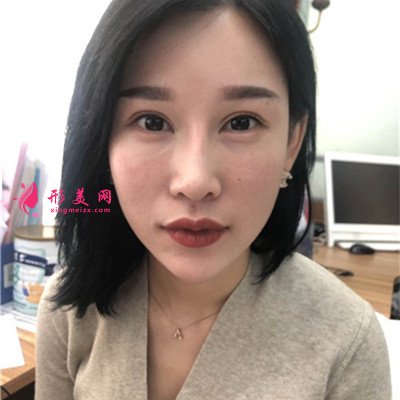 成都眼部修復(fù)手術(shù)術(shù)后效果展示