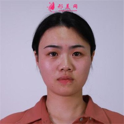 長(zhǎng)沙鼻綜合手術(shù)恢復(fù)情況對(duì)比