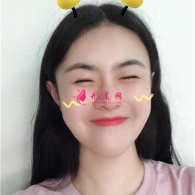 長(zhǎng)沙鼻綜合手術(shù)恢復(fù)情況對(duì)比 術(shù)后 長(zhǎng)沙鼻綜合手術(shù)恢復(fù)情況對(duì)比