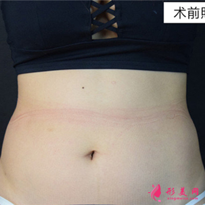 湖南腰腹吸脂術(shù)后恢復(fù)情況分析