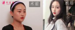 成都西嬋醫(yī)療美容醫(yī)院 雙眼皮 效果 案例分享_對比圖_評價