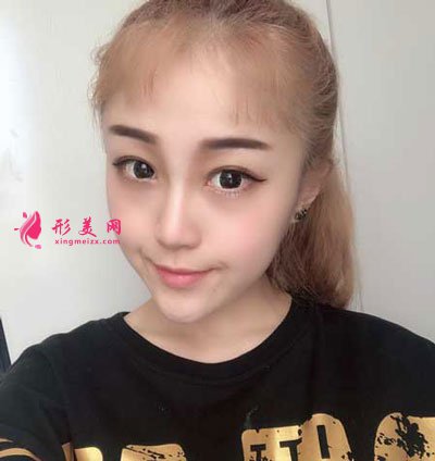 西安美萊整形美容醫(yī)院隆鼻手術(shù)的案例