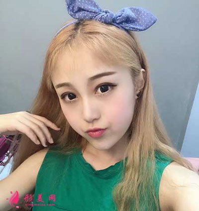 西安美萊整形美容醫(yī)院隆鼻手術(shù)的案例