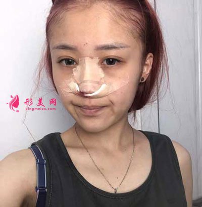 西安美萊整形美容醫(yī)院隆鼻手術(shù)的案例