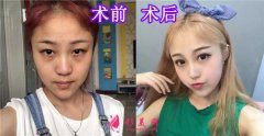 陜西同濟(jì)醫(yī)院隆鼻怎么樣？案例_評價(jià)_對比_價(jià)格_醫(yī)生