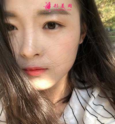 找八大處王太玲醫(yī)生做雙眼皮手術(shù)