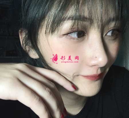大連醫(yī)科大學(xué)第二附屬醫(yī)院整形外科做隆鼻一個(gè)月經(jīng)歷分享