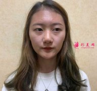 大連醫(yī)科大學第二附屬醫(yī)院整形外科做隆鼻一個月經(jīng)歷分享