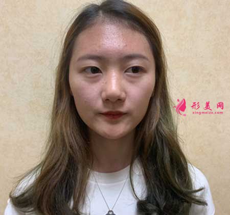 大連醫(yī)科大學(xué)第二附屬醫(yī)院整形外科做隆鼻一個(gè)月經(jīng)歷分享