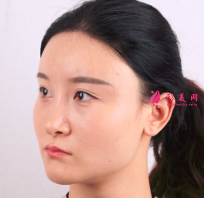 上海華美醫(yī)療美容醫(yī)院V-LINE瓜子臉手術(shù)案例