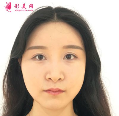 上海華美醫(yī)療美容醫(yī)院V-LINE瓜子臉手術(shù)案例