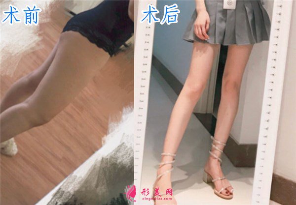 廈門安黛美醫(yī)療整形美容大腿吸脂案例