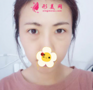 長沙麗都整形醫(yī)院激光去眼袋對比圖 大媽變美女 年輕好幾歲