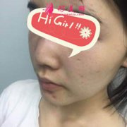 在南京維多利亞整形醫(yī)院做的假體墊下巴好美 臉型線條流暢