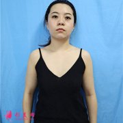 重慶聯(lián)合麗格美容醫(yī)院小仙女自體脂肪隆胸恢復(fù)效果反饋