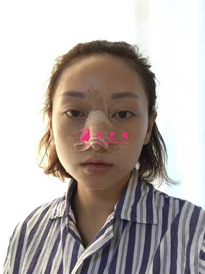 軍建--鼻綜合術后3天圖片