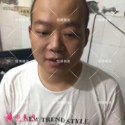 在成都恒博植發(fā)醫(yī)院做種植頭發(fā)，終于告別了“地中?！?></a><p class=