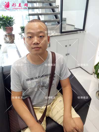 植發(fā)術后4天圖片