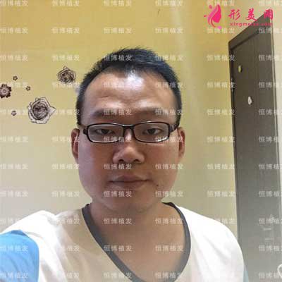 植發(fā)術后30天圖片