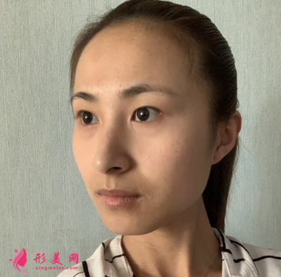 術(shù)前照片