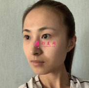 成都美容整形醫(yī)院雙眼皮案例 術(shù)后70天效果對(duì)比圖分享