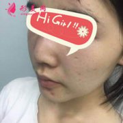 南京維多利亞整形醫(yī)院做的假體墊下巴好美 臉型線條流暢