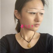 小姐姐眼在北京八大處部綜合術(shù)后恢復(fù)效果反饋