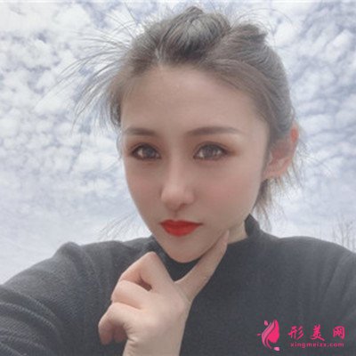 昆明小姐姐眼部綜合術(shù)后恢復(fù)效果反饋 術(shù)后 昆明小姐姐眼部綜合術(shù)后恢復(fù)效果反饋