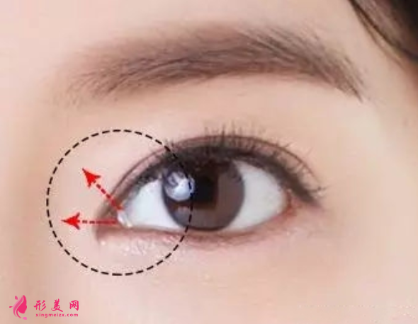 開眼角修復(fù)是怎么做的