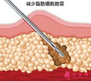吸脂手術大概費用