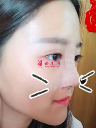 鄭州締萊美醫(yī)療美容醫(yī)院鼻部多項案例