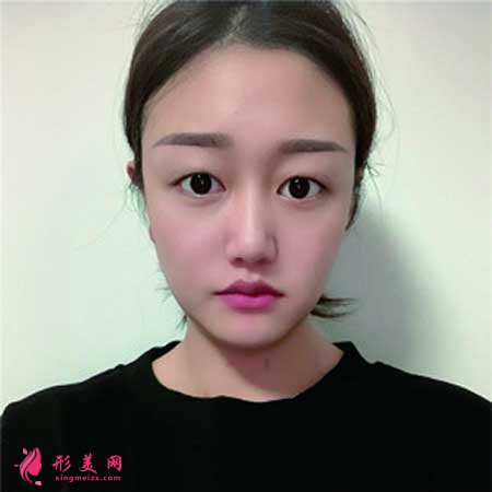 華美紫馨陳楊做雙眼皮案例分享,附帶價格表 華美紫馨陳楊做雙眼皮案例分享,附帶價格表