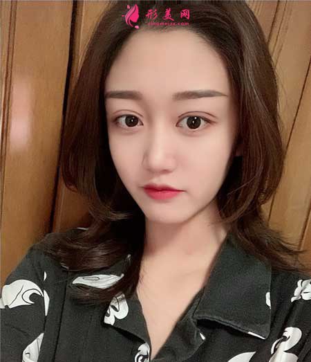 華美紫馨陳楊做雙眼皮案例分享華美紫馨陳楊做雙眼皮案例分享,附帶價格表 華美紫馨陳楊做雙眼皮案例分享華美紫馨陳楊做雙眼皮案例分享,附帶價格表