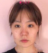 去八大處找靳小雷做了下頜角手術(shù)后,小臉不是夢