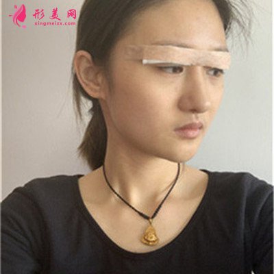 昆明小姐姐眼部綜合術(shù)后恢復(fù)效果反饋