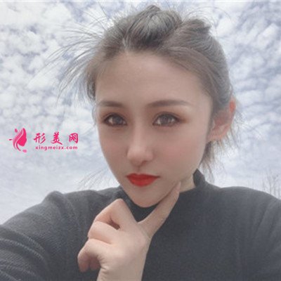 昆明小姐姐眼部綜合術(shù)后恢復(fù)效果反饋 術(shù)后 昆明小姐姐眼部綜合術(shù)后恢復(fù)效果反饋