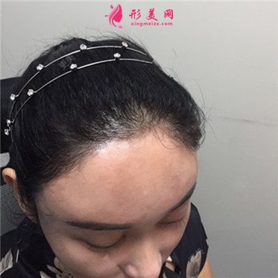 上海種植發(fā)際線術(shù)后恢復(fù)效果反饋