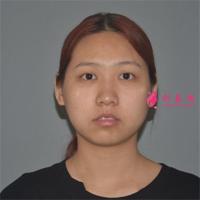 長沙小姐姐吸脂瘦臉術(shù)后恢復(fù)效果分享