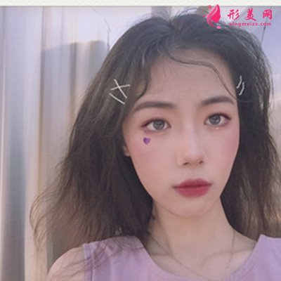 無錫鼻綜合手術術后恢復情況對比圖分享