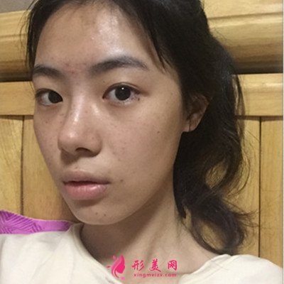 無錫鼻綜合手術術后恢復情況對比圖分享