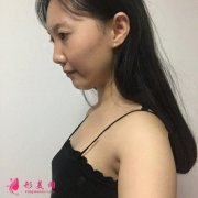 武漢假體隆胸領(lǐng)哪里好？小姐姐術(shù)后恢復(fù)效果展示