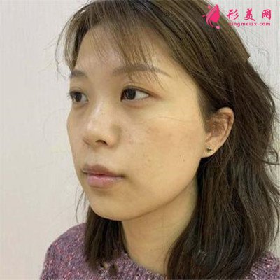 武漢切開(kāi)雙眼皮手術(shù)術(shù)后效果反饋