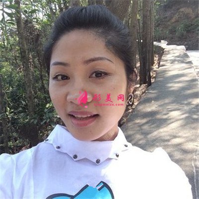 深圳小仙女的鼻綜合術(shù)后效果反饋